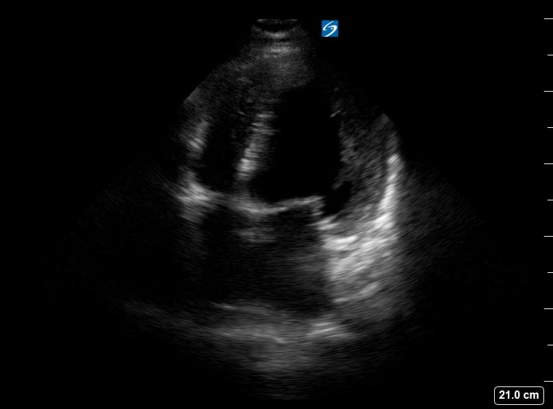 A4C Depressed Ef16 (Ef~35%