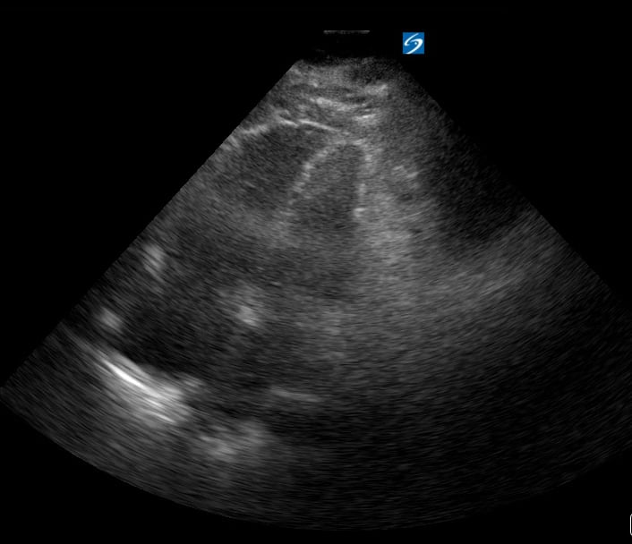 A4C R Heart Strain3 (+Mcconnell’S Sign) - Video