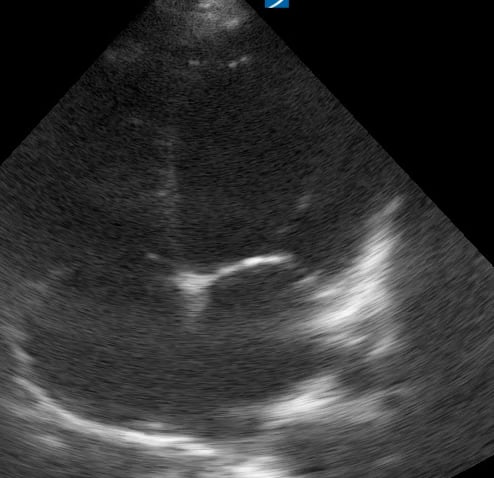 A4C Depressed Ef21 (Ef ~15%) - Video