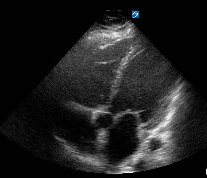A4C Depressed Ef5 (Ef ~20%) - Video