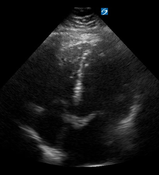 A4C Depressed Ef8 (Ef ~20%) - Video