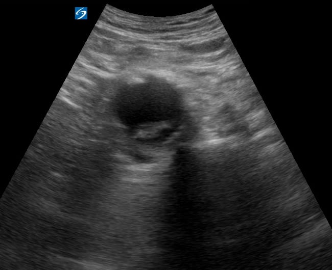 Aaa6 (Short Axis) - Video
