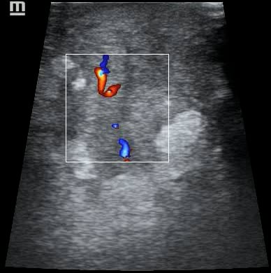 Abscess: Present and objects: Subcutaneous Thickening - Video