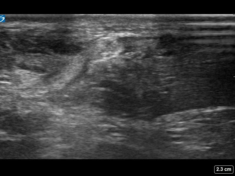 Achilles Tear3 - Video