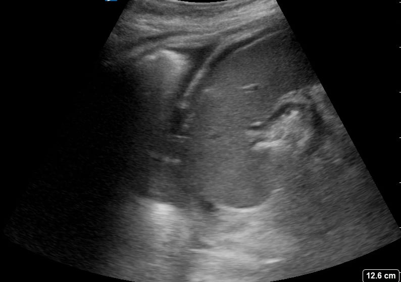 Luq Free Fluid11 (With Pleural Effusion) - Video