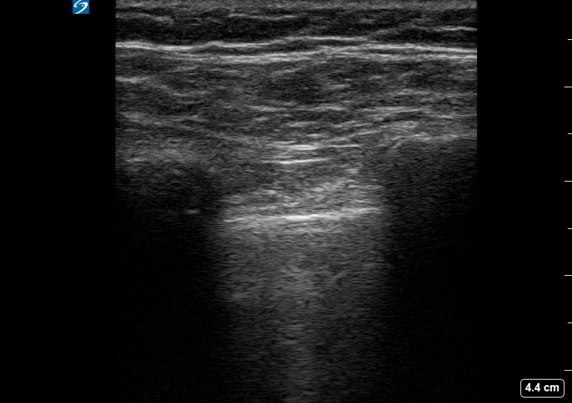 (-) Pneumothorax10 - Video