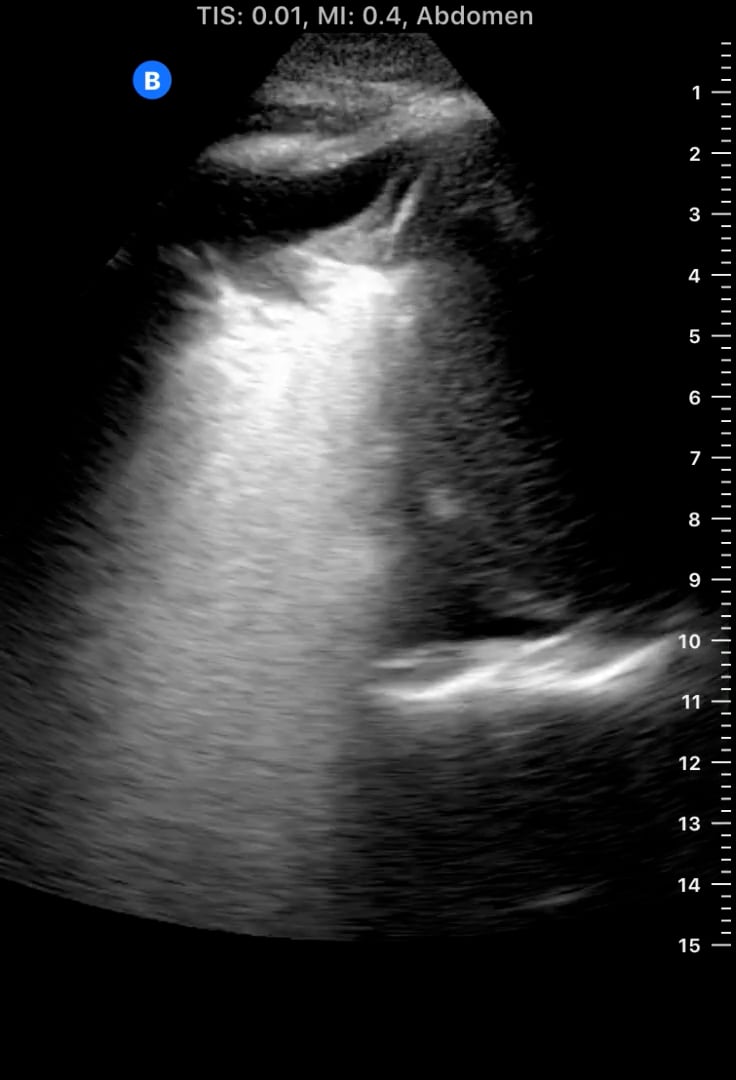 Consolidation + Air Bronchograms6 - Video