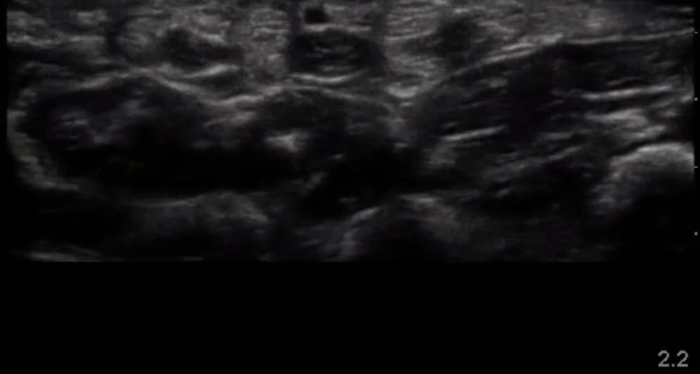 Ring Finger Diagnostic (Short Axis) - Video