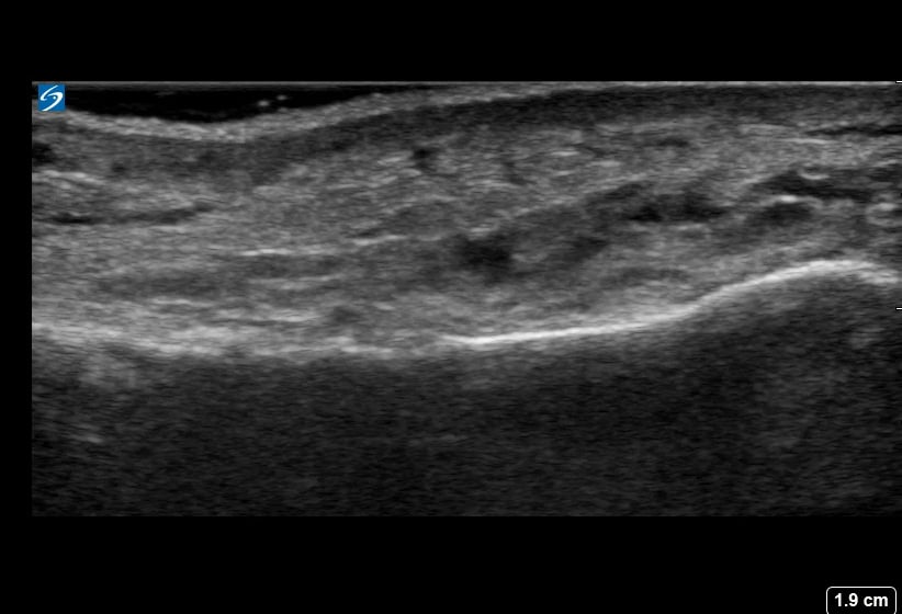 Distal Fib Avulsion Fracture2 - Video