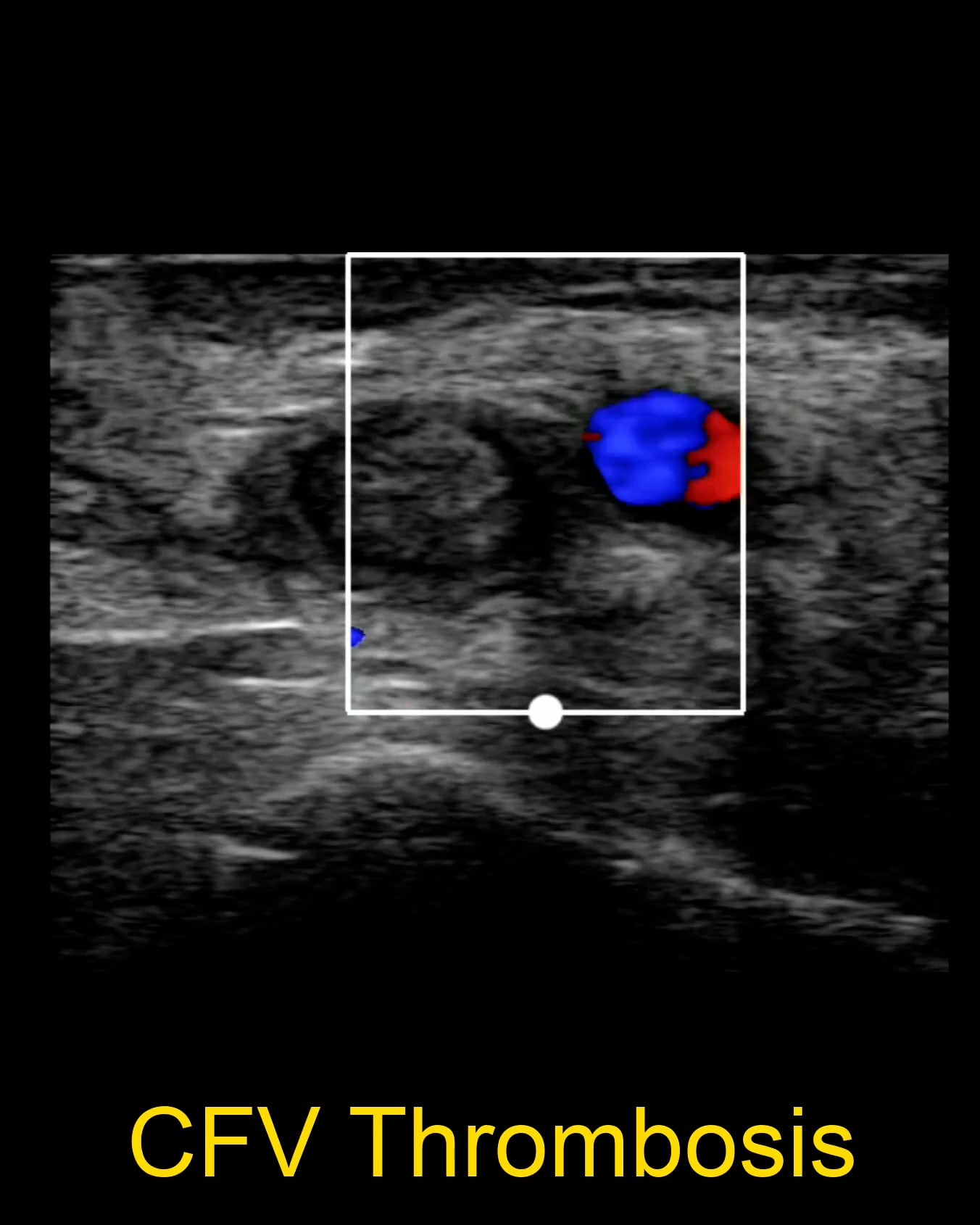 Dvt Pathology - Video