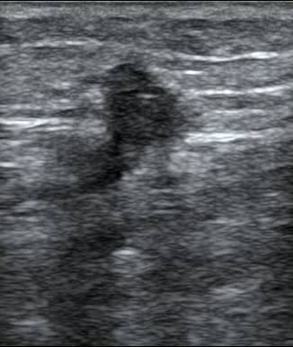 DVT: Present - Video