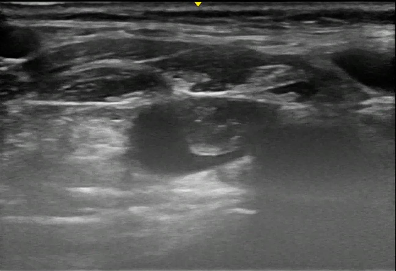 DVT: Present - Video