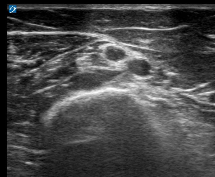 Deep Brachial Dvt1 - Video