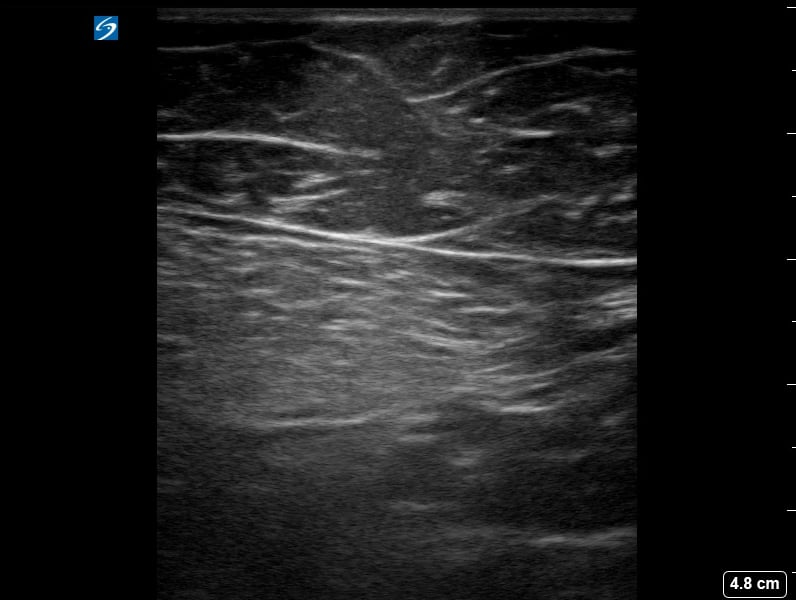 Femoral (-) Dvt15 - Video