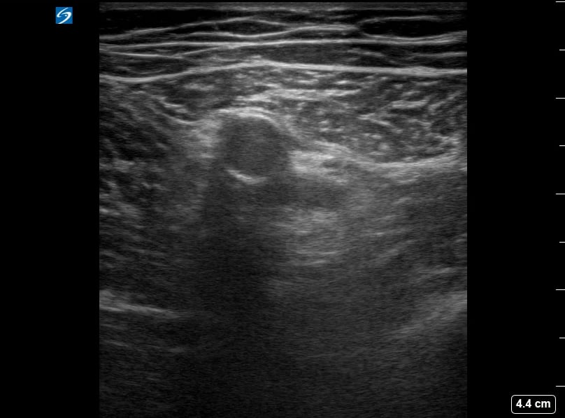 Femoral (-) Dvt14 - Video