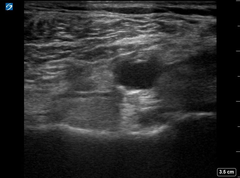 Popliteal (-) Dvt7 - Video