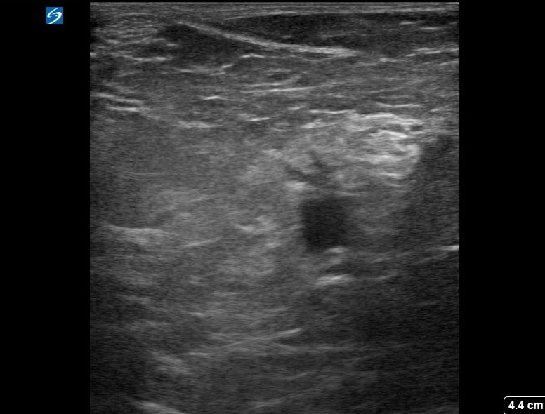 Popliteal (-) Dvt11 - Video