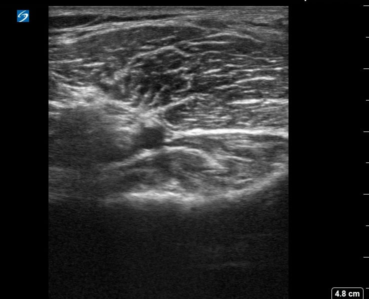 Popliteal (-) Dvt9 - Video