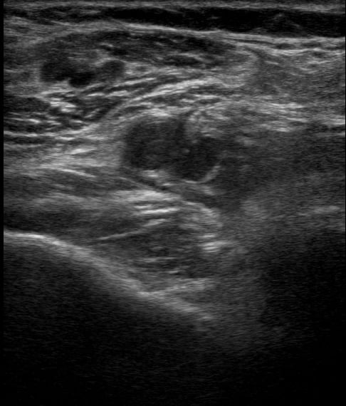 Popliteal Dvt6 - Video