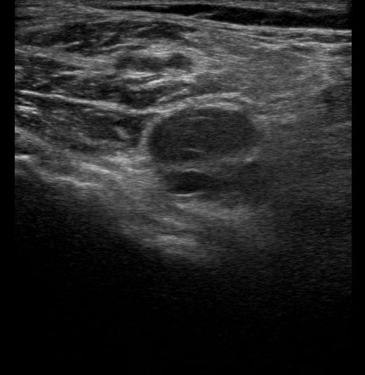 Popliteal Dvt7 - Video