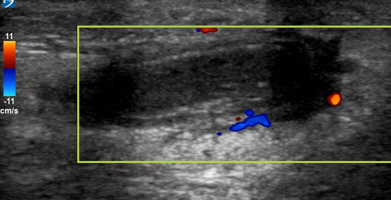 Cephalic Vein Dvt1 (With Thrombophlebitis) - Video
