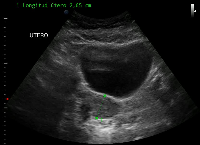 Empty Uterus - Video