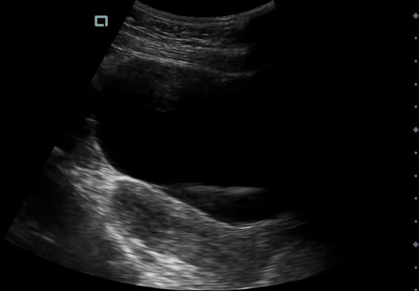 Empty Uterus3 - Video