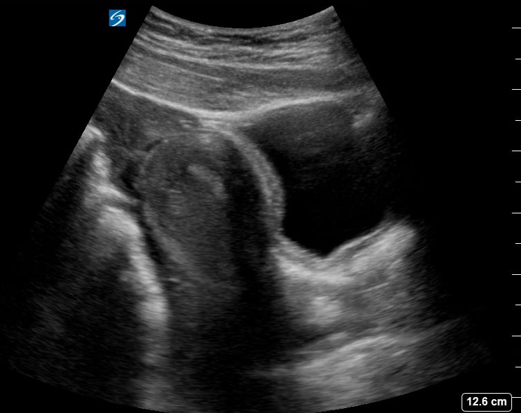 Pelvic Free Fluid15 (Ruptured Hemorrhagic Ovarian Cyst) - Video