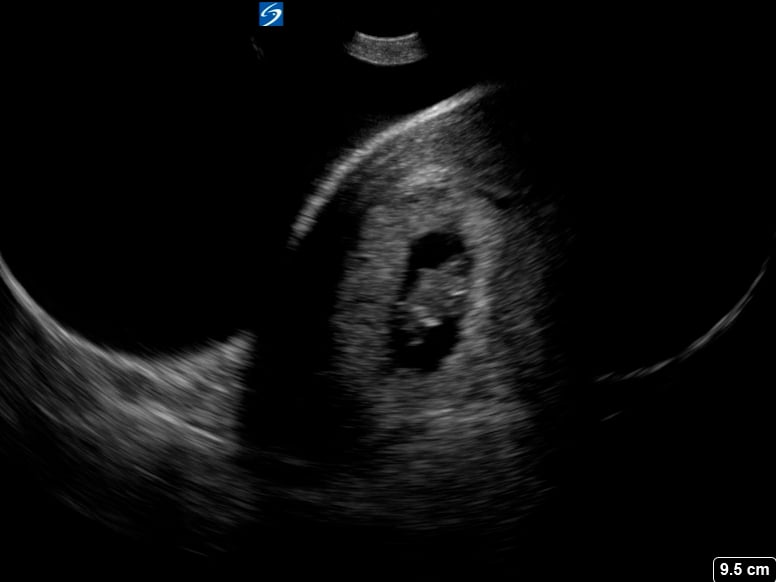 Intrauterine Gestational Sac: Present and objects: Fetal Pole - Video