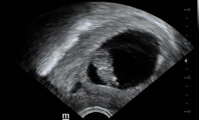 Intrauterine Gestational Sac: Present