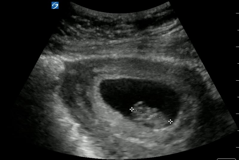Intrauterine Gestational Sac: Present