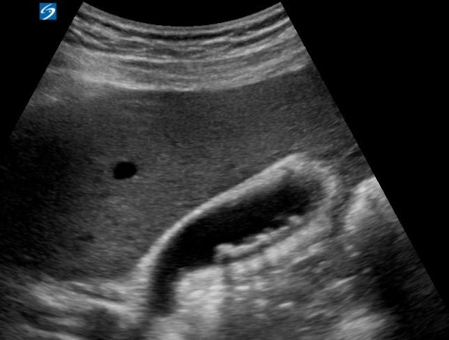 Multiple Gallstones + Cholecystitis2 (+Sono Murphy’S) - Video