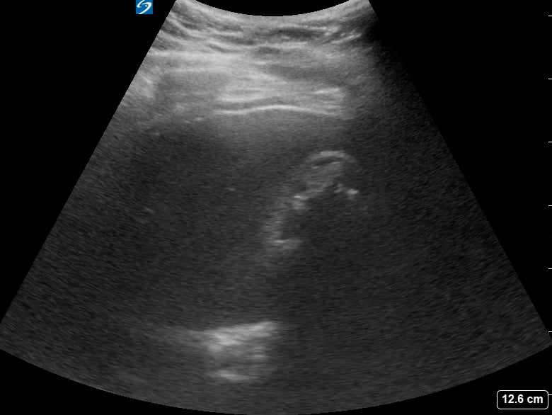 Gallbladder Full Of Stones3 (+Wall Echo Shadow (Wes) Sign) - Video