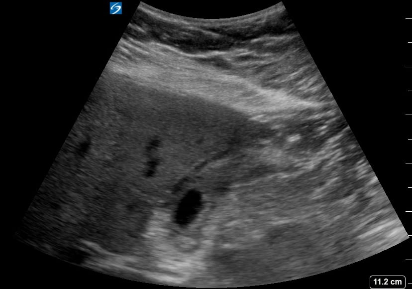Large Gallstone + Cholecystits2 (+Sono Murphy’S