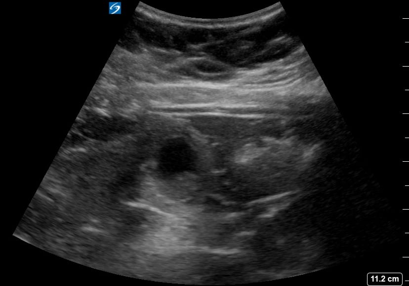 Large Gallstone + Cholecystitis3 (+Sono Murphy’S