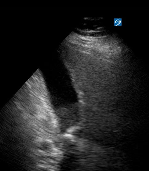 Multiple Gallstones In Neck1 - Video