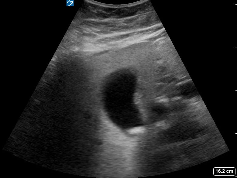 Gallstone In Gb Neck3 - Video