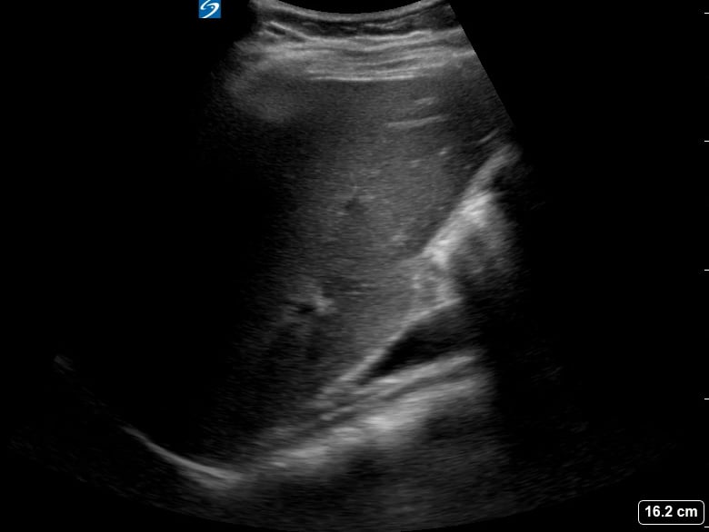 Gallbladder Full Of Stones2 (+Wall Echo Shadow (Wes) Sign) - Video