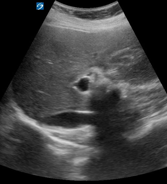 Gallbladder Full Of Stones1 (+Wall Echo Shadow (Wes) Sign) - Video