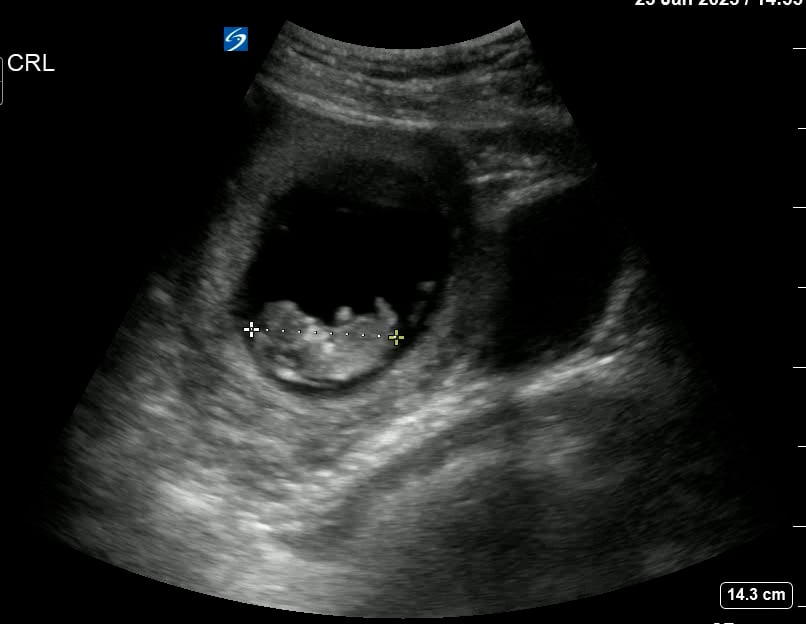 Intrauterine Gestational Sac: Present