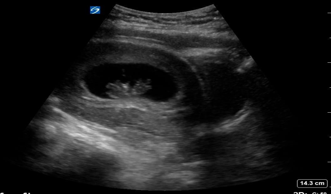 Intrauterine Gestational Sac: Present
