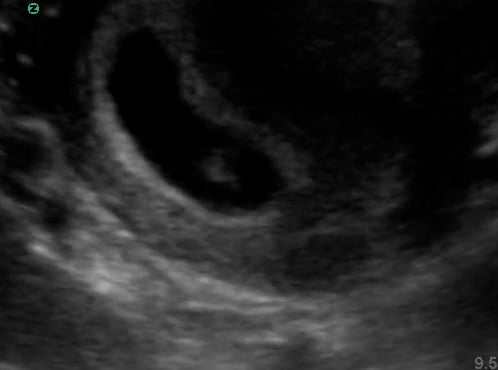 Intrauterine Gestational Sac: Present