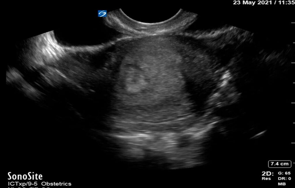 Intrauterine Gestational Sac: Present