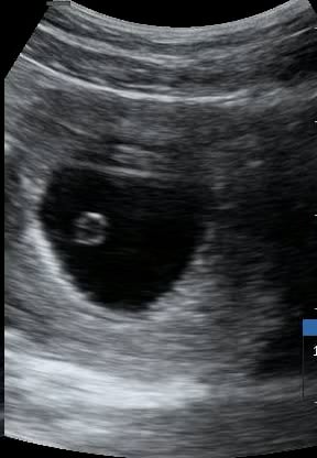 Intrauterine Gestational Sac: Present