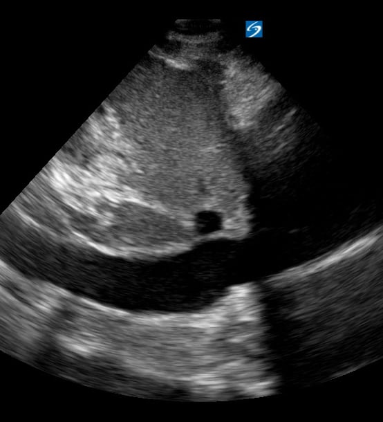 Plethoric Ivc7 (> 2.5Cm) - Video