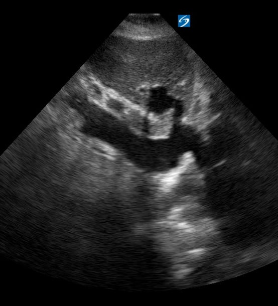 Plethoric Ivc5 (> 2.5Cm
