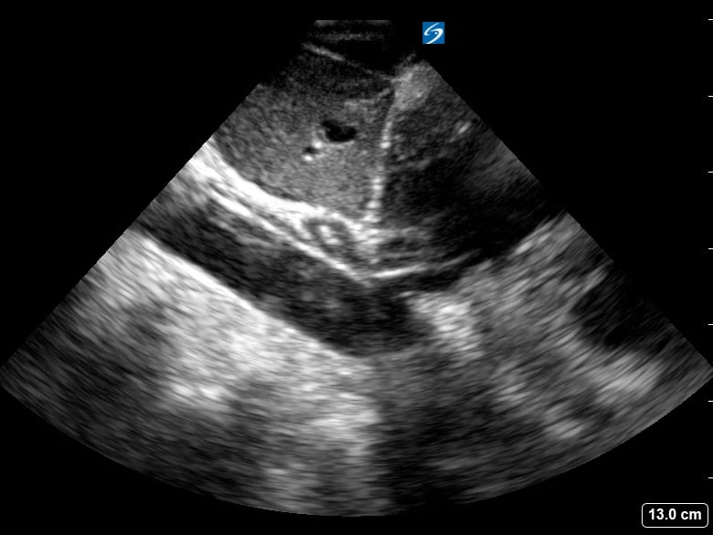 Plethoric Ivc21 (> 2.5Cm
