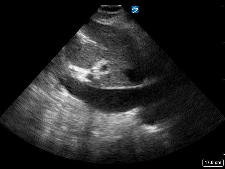 Plethoric Ivc13 (> 2.5Cm) - Video