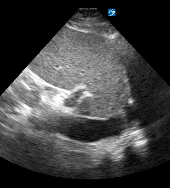Plethoric Ivc4 (> 2.5Cm) - Video
