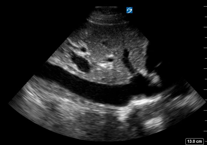 Plethoric Ivc20 (< 50% Collapse) - Video